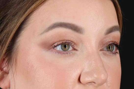 Brow Lift Before & After Patient #1588