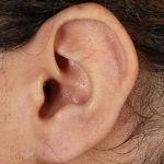 Earlobe Repair Before & After Patient #1791