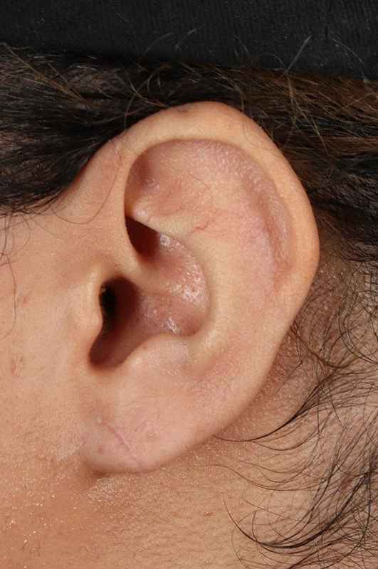 Earlobe Repair Before & After Patient #1791