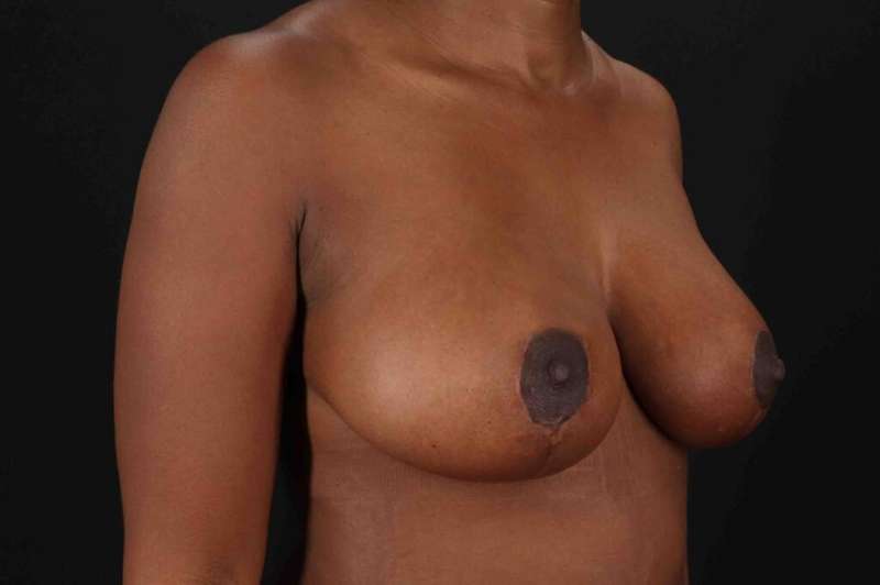 Breast Reduction with Lift Before & After Patient #883