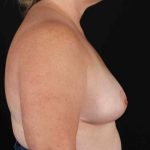 Breast Reduction with Lift Before & After Patient #894