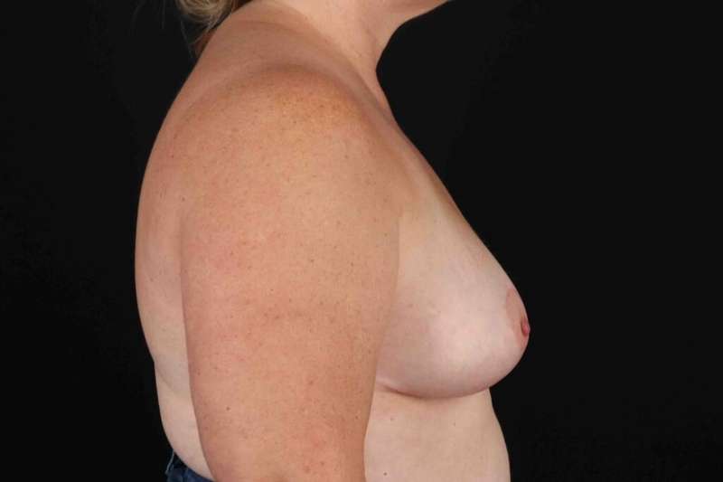 Breast Reduction with Lift Before & After Patient #894