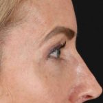 CO2 Laser Before & After Patient #2070