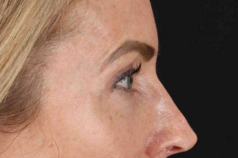 Laser Before & After Patient #2070