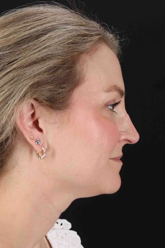 Laser Before & After Patient #2081