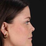CO2 Laser Before & After Patient #2092