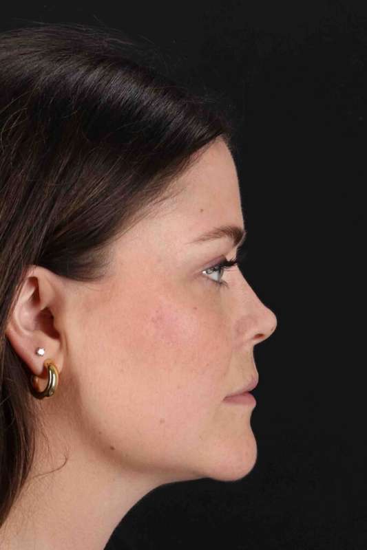 Laser Before & After Patient #2092