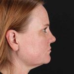 CO2 Laser Before & After Patient #2103