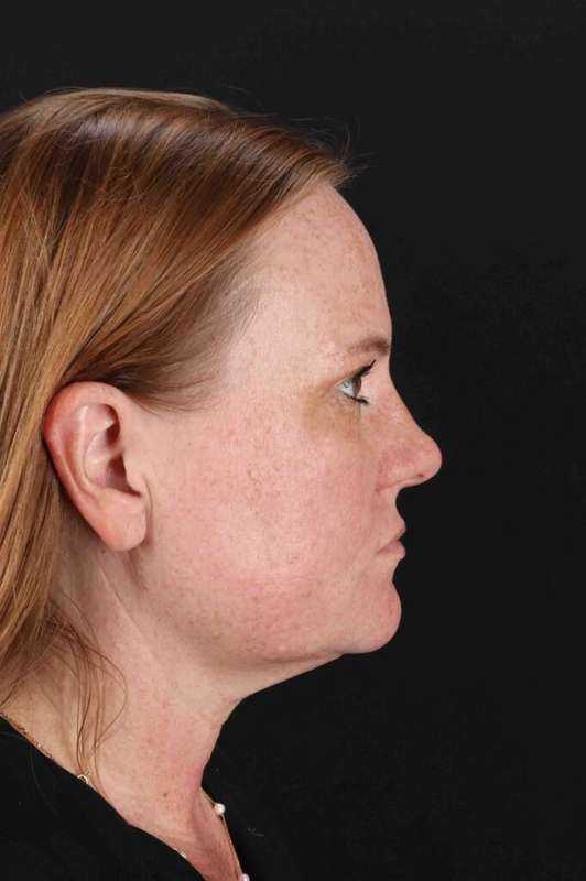 Laser Before & After Patient #2103