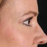 CO2 Laser Before & After Patient #2114