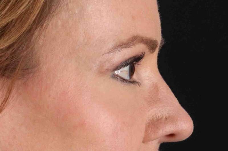 Laser Before & After Patient #2114