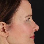 CO2 Laser Before & After Patient #2125