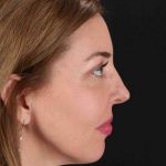 CO2 Laser Before & After Patient #2136