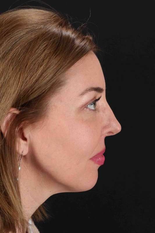 Laser Before & After Patient #2136