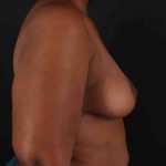 Breast Reduction with Lift Before & After Patient #917