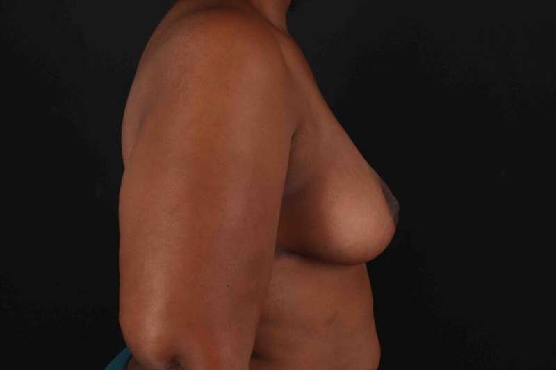 Breast Reduction with Lift Before & After Patient #917