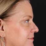 Chemical Peel Before & After Patient #2169