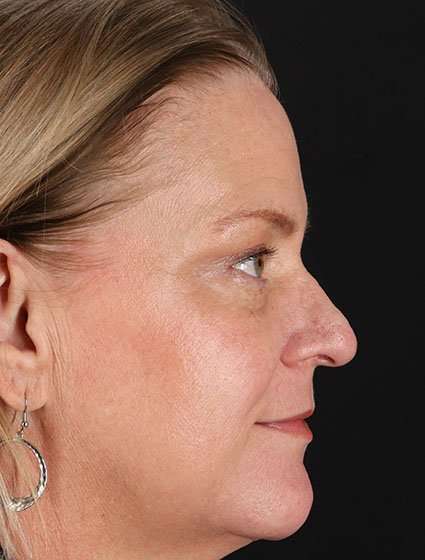 Chemical Peel Before & After Patient #2169