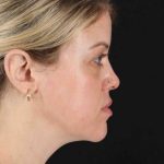 Chemical Peel Before & After Patient #2180