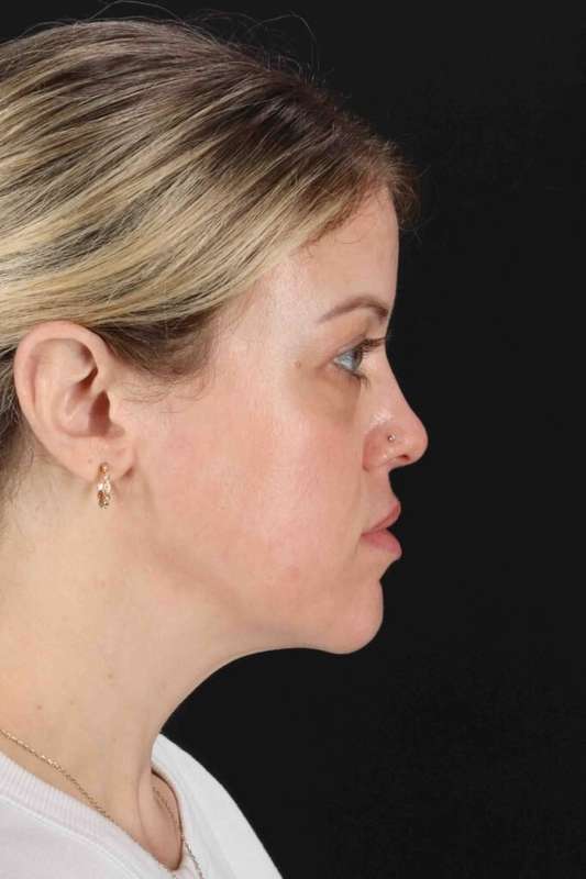 Chemical Peel Before & After Patient #2180