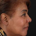 Chemical Peel Before & After Patient #2227