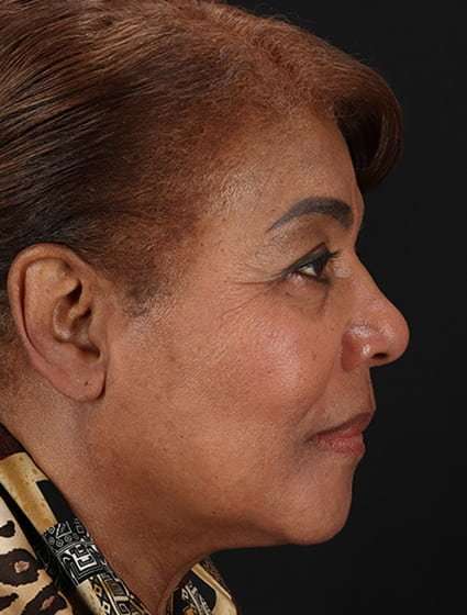 Chemical Peel Before & After Patient #2227