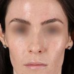 Cosmetic Injectables Before & After Patient #2236