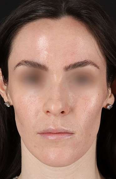 Cosmetic Injectables Before & After Patient #2236