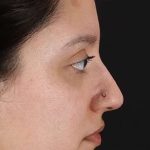 Cosmetic Injectables Before & After Patient #2253
