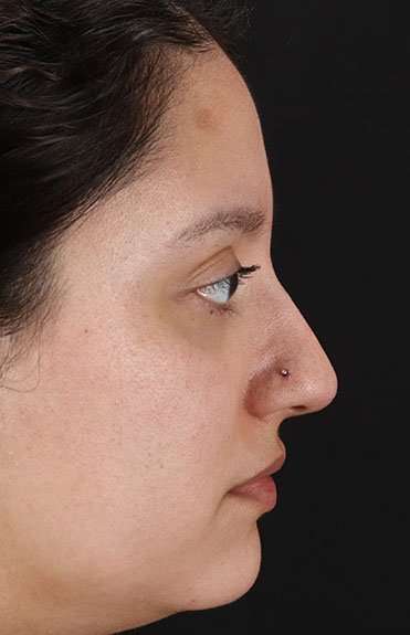 Cosmetic Injectables Before & After Patient #2253