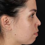 Cosmetic Injectables Before & After Patient #2264