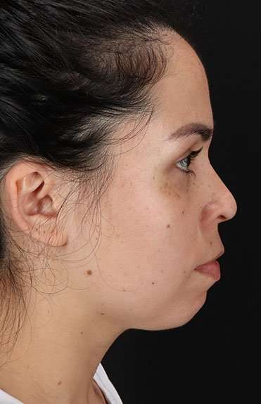 Cosmetic Injectables Before & After Patient #2264