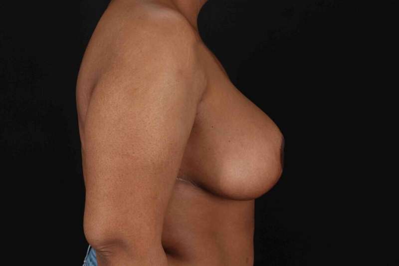 Breast Reduction with Lift Before & After Patient #928