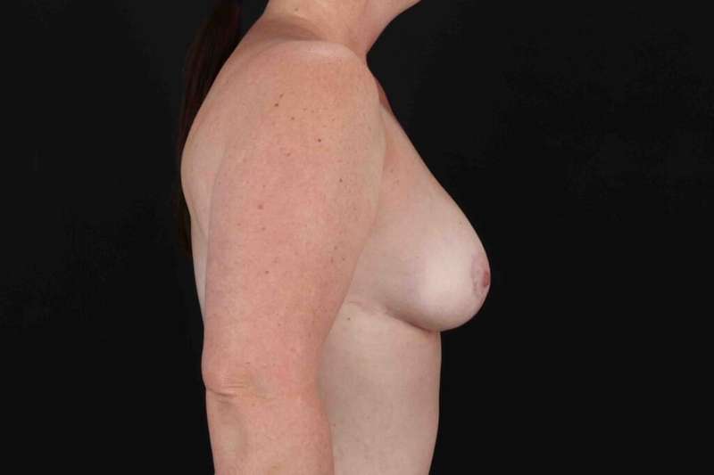 Breast Reduction with Lift Before & After Patient #950