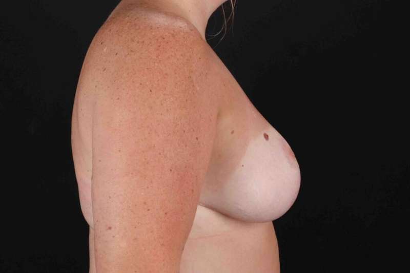 Breast Reduction with Lift Before & After Patient #961