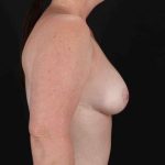 Breast Reduction with Lift Before & After Patient #972