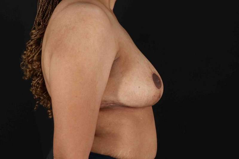 Breast Reduction with Lift Before & After Patient #1005