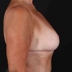 Breast Reduction with Lift Before & After Patient #1016