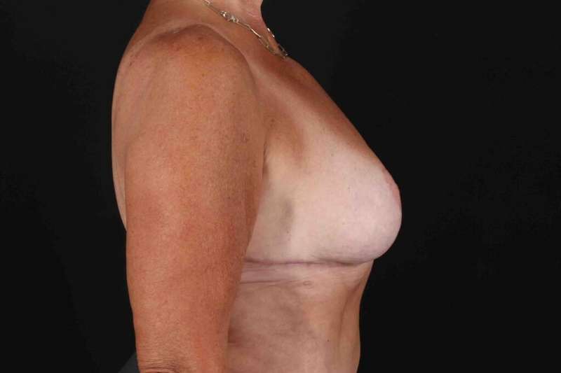 Breast Reduction with Lift Before & After Patient #1016