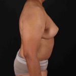 Breast Reconstruction Before & After Patient #1038