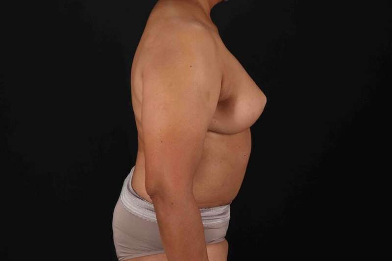 Breast Reconstruction Before & After Patient #1038