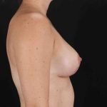 Breast Lift Before & After Patient #1071