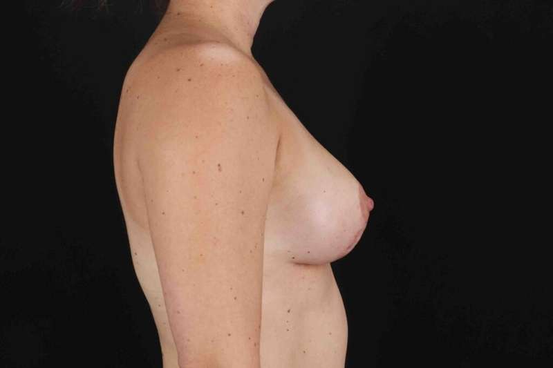Breast Lift Before & After Patient #1071