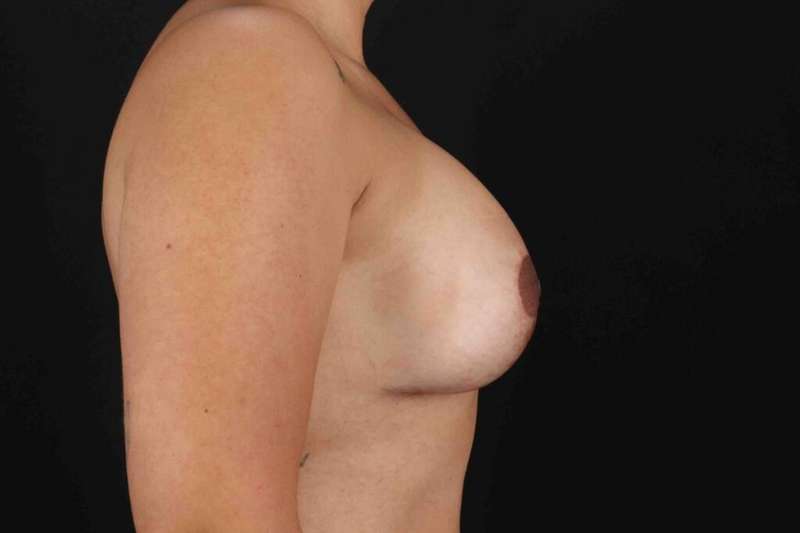 Breast Lift Before & After Patient #1082
