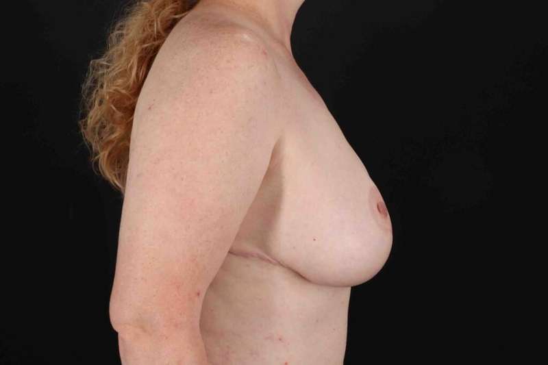 Breast Lift Before & After Patient #1115