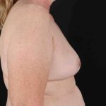 Breast Lift Before & After Patient #1181