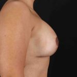 Breast Augmentation with Implants Before & After Patient #1214
