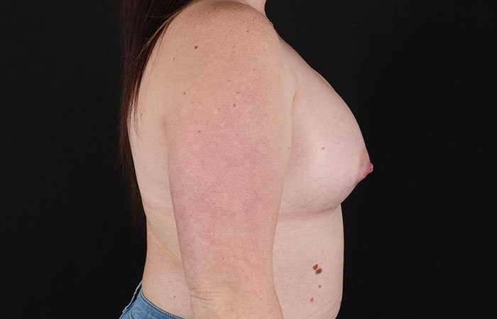 Breast Augmentation with Implants Before & After Patient #1258