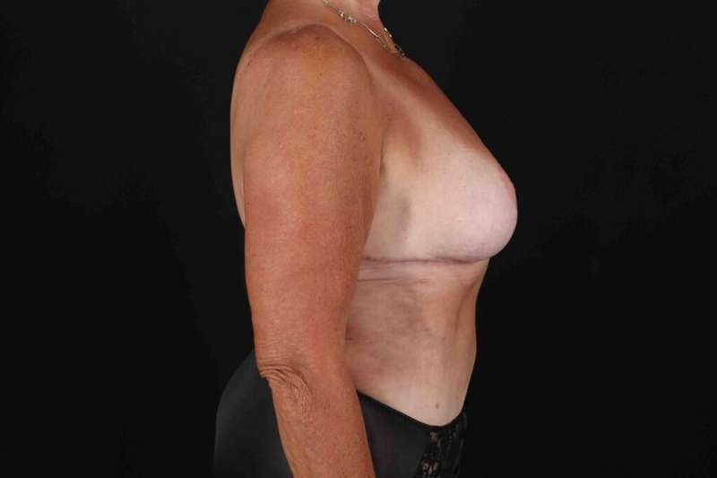 Mommy Makeover Before & After Patient #1353