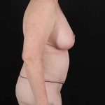 Liposuction Before & After Patient #1403
